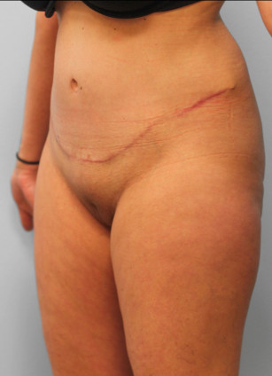 After Image: Abdominoplasty & Lipo – Dr. Tucker - left-front-oblique