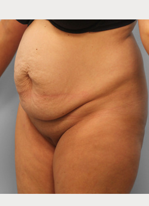 Before Image: Abdominoplasty & Lipo – Dr. Tucker - left-front-oblique