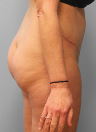 After Image: Abdominoplasty & Lipo – Dr. Tucker - right-side