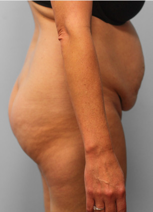 Before Image: Abdominoplasty & Lipo – Dr. Tucker - right-side