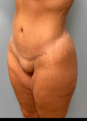 After Image: Mommy Makeover- Dr. Tucker - left-front-oblique