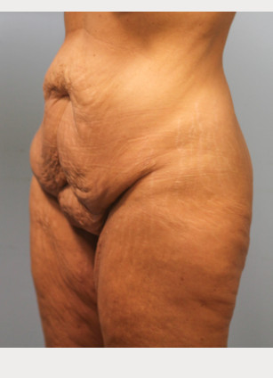 Before Image: Mommy Makeover- Dr. Tucker - left-front-oblique