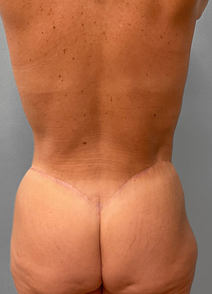 After Image: Mommy Makeover- Dr. Tucker - back
