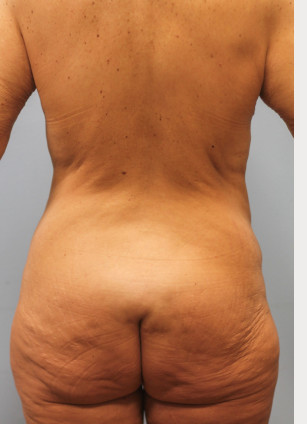 Before Image: Mommy Makeover- Dr. Tucker - back
