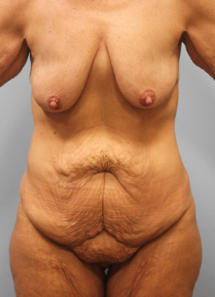 Before Image: Mommy Makeover- Dr. Tucker - front