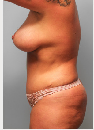 After Image: Mommy Makeover- Dr. Tucker - left-side