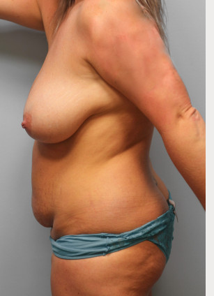 Before Image: Mommy Makeover- Dr. Tucker - left-side