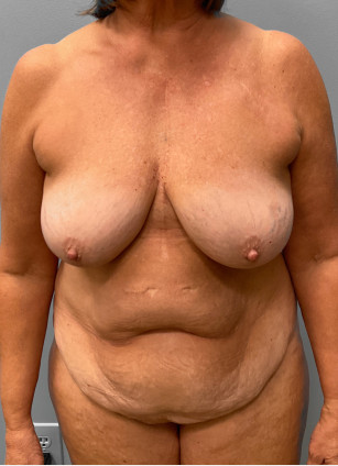 Before Image: Abdominoplasty & Breast Lift – Dr. Tucker - front