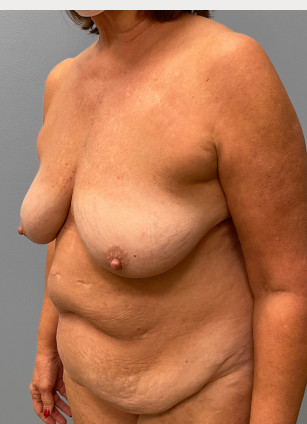 Before Image: Abdominoplasty & Breast Lift – Dr. Tucker - left-front-oblique