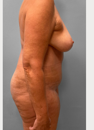 After Image: Abdominoplasty & Breast Lift – Dr. Tucker - right-side