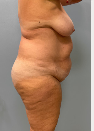 Before Image: Abdominoplasty & Breast Lift – Dr. Tucker - right-side