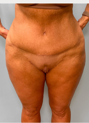 After Image: Abdominoplasty & Thigh Lift – Dr. Tucker - front
