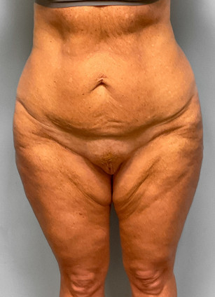 Abdominoplasty & Thigh Lift – Dr. Tucker