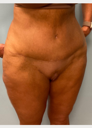 After Image: Abdominoplasty & Thigh Lift – Dr. Tucker - right-front-oblique