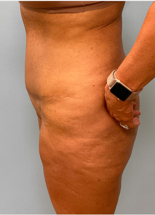 After Image: Abdominoplasty & Thigh Lift – Dr. Tucker - left-side