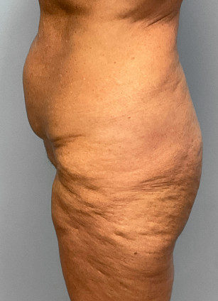 Before Image: Abdominoplasty & Thigh Lift – Dr. Tucker - left-side