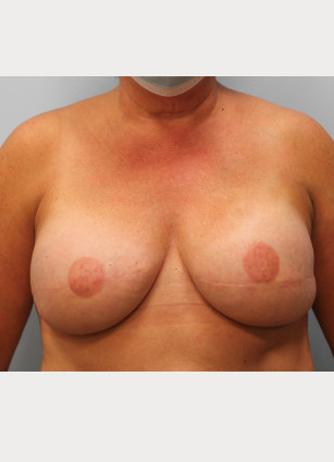 After Image: Breast Reconstruction – Dr. Tucker - front