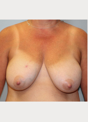Before Image: Breast Reconstruction – Dr. Tucker - front