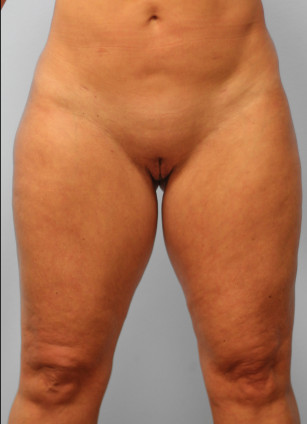 After Image: Liposuction- Dr. Tucker - front
