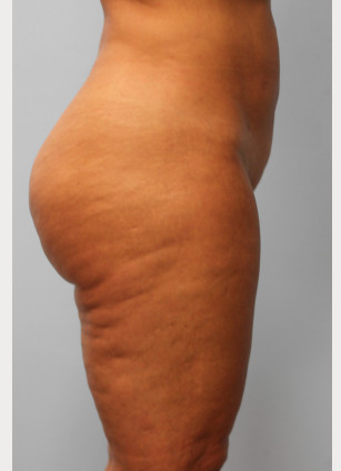 After Image: Liposuction- Dr. Tucker - right-side