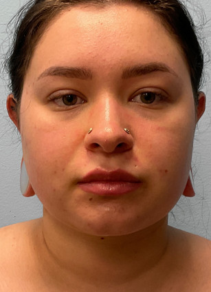 After Image: Neck Lipo- Dr. Tucker - front