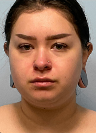 Before Image: Neck Lipo- Dr. Tucker - front