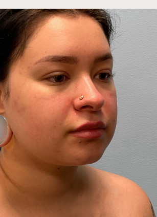 After Image: Neck Lipo- Dr. Tucker - right-front-oblique