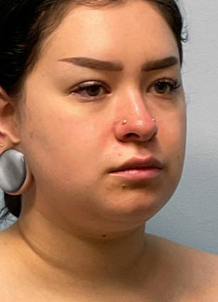 Before Image: Neck Lipo- Dr. Tucker - right-front-oblique