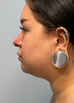 Before Image: Neck Lipo- Dr. Tucker - front