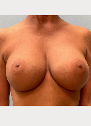 After Image: Mommy Makeover – Dr. Tucker - front