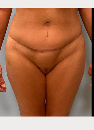 After Image: Mommy Makeover – Dr. Tucker - front