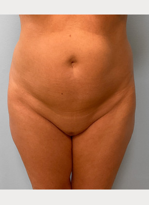 Before Image: Mommy Makeover – Dr. Tucker - front