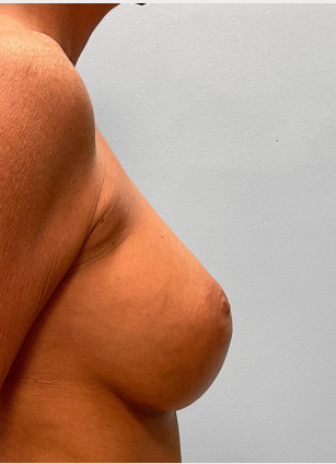 After Image: Mommy Makeover – Dr. Tucker - right-side