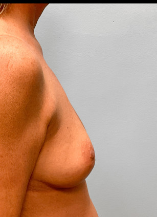 Before Image: Mommy Makeover – Dr. Tucker - right-side
