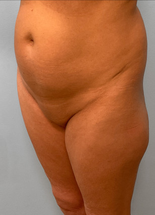 Before Image: Mommy Makeover – Dr. Tucker - left-front-oblique