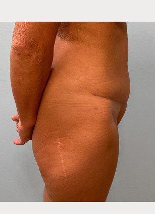 After Image: Mommy Makeover – Dr. Tucker - right-side