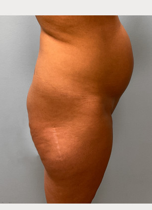 Before Image: Mommy Makeover – Dr. Tucker - right-side