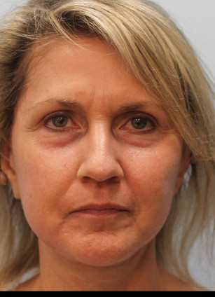 After Image: Facelift & Laser – Dr. Tucker - front