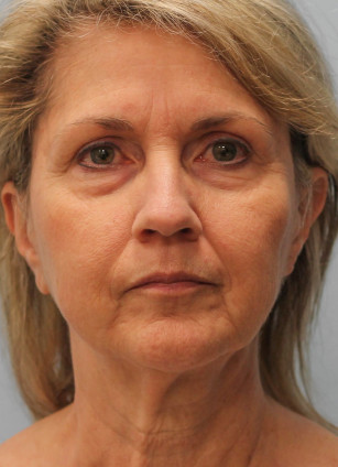 Before Image: Facelift & Laser – Dr. Tucker - front