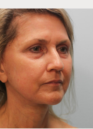 After Image: Facelift & Laser – Dr. Tucker - right-front-oblique