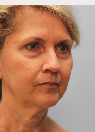 Before Image: Facelift & Laser – Dr. Tucker - right-front-oblique