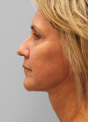 After Image: Facelift & Laser – Dr. Tucker - left-side