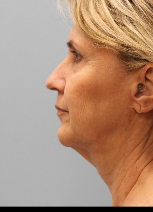 Before Image: Facelift & Laser – Dr. Tucker - left-side
