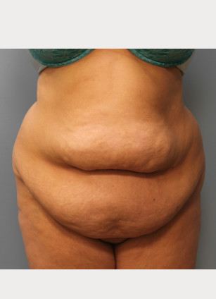 Before Image: Abdominoplasty & Lipo – Dr. Howell - front