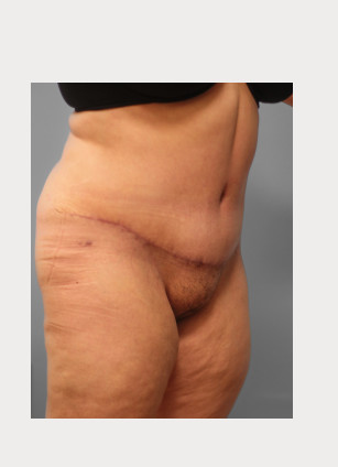 After Image: Abdominoplasty & Lipo – Dr. Howell - right-front-oblique