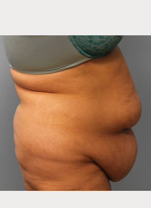 Before Image: Abdominoplasty & Lipo – Dr. Howell - right-side
